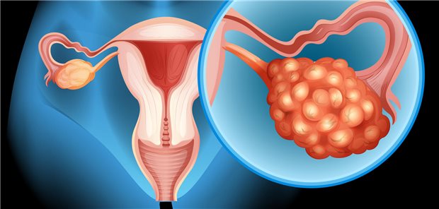 Angesichts des höheren Stress- und Angstpegels von Frauen unter 50 und der Prävalenz von Ovarialkrebs bei Frauen unter 40 wagen Forschende der britischen ROCkeTS-Studie die Vermutung, dass Tests auf Ovarialkrebs bei Frauen unter 40 mehr Schaden anrichten als nützen.