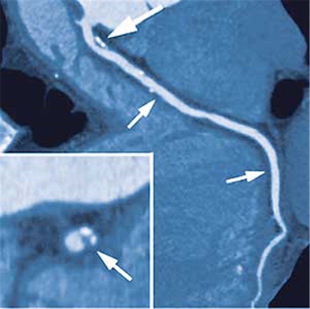 Weiche Koronarplaques sind schlecht für Männer Angio-CT: Im Bild ein Koronarplaque (Pfeil) mit verkalkten (hell) und weichen Anteilen.