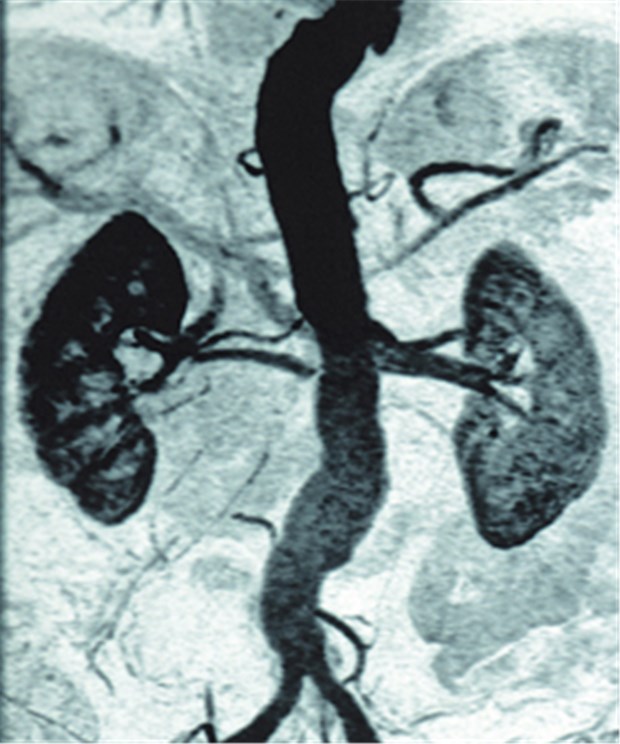 Screening nicht nur für Männer! Angiografie der Aorta: Um Bauchaortenaneurysmen früh aufzuspüren, empfiehlt das IQWiG ein Ultraschall-Screening für Männer ab 65 Jahre.