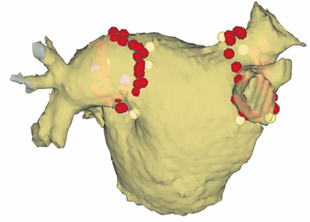 Katheterablation - eine neue Therapieoption bei Vorhofflimmern im Aufschwung Ansicht des linken Vorhofs in 3-D-Darstellung. Die roten Punkte markieren die Ablationsorte für die zirkumferenzielle Pulmonalvenenisolation.