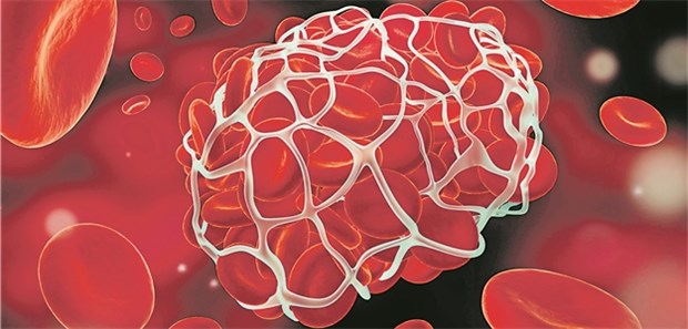 Antikoagulation mit Rivaroxaban/ASS? Erhöhtes Blutungsrisiko kann Ausschlusskriterium sein.