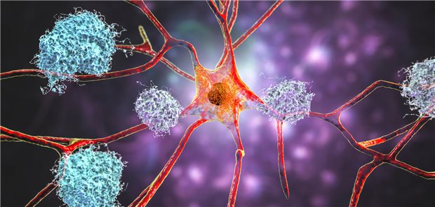 Antikörper gegen Beta-Amyloid sind in den USA bereits zugelassen. In der EU wird die Zulassung wahrscheinlich sobald nicht kommen: Das CHMP gab heute eine negative Empfehlung.