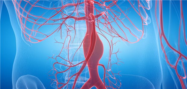 Aortenaneurysma: Eine Placebo-kontrollierte Studie legt nahe, dass Doxycyclin das weitere Wachstum nicht bremst. 