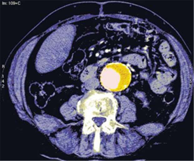 Ultraschall-Screening rettet Leben Aortenaneurysma (gelb) im axialen CT.