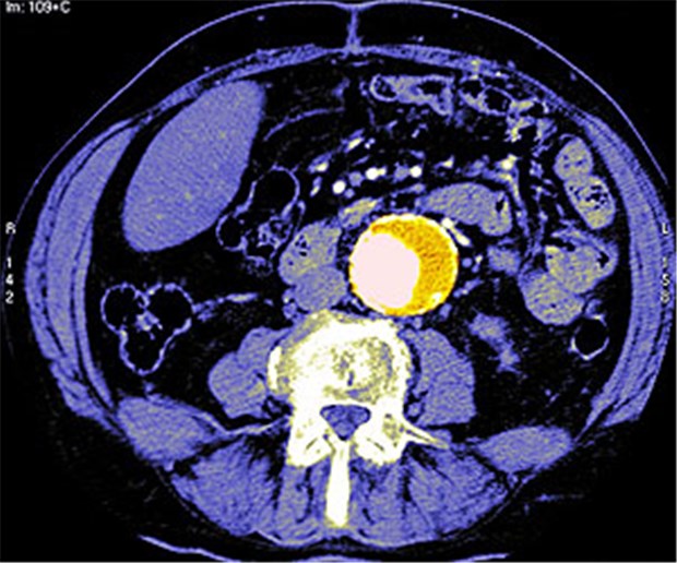 Obst bannt die Gefahr Aortenaneurysma (gelb) im axialen CT.