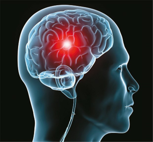 Schon bei TIA: am besten in die Stroke-Unit! Apoplexie: eine frühzeitige Intervention nützt. © Kaulitzki / fotolia.de