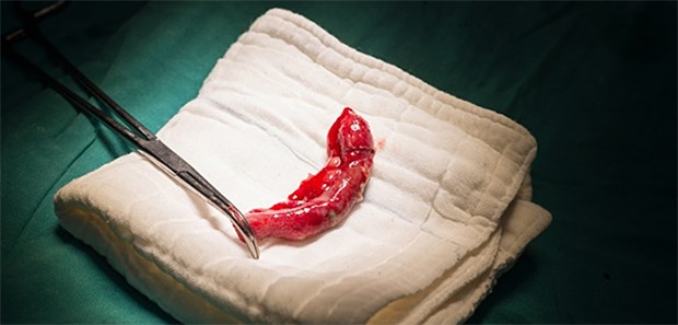 Appendix nach Appendektomie.