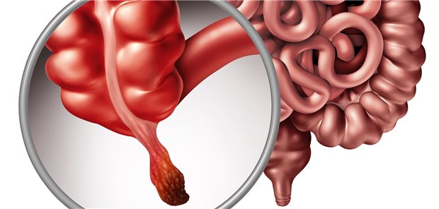 Appendizitis: In seltenen Fällen kann eine Krebserkrankung dahinterstecken.