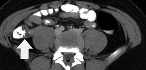 Mehrschicht-CT hilft bei Appendizitis Appendizitis bei einem 12-jährigen Jungen. In der CT-Aufnahme mit Kontrastmittelsieht man das "Pfeilkopfzeichen" (weißer Pfeil) an der Basis der entzündeten Appendix.