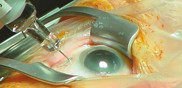 BVA klopft Kassen auf die Finger Applikation eines VEGF-Inhibitors: Gesetzlich versicherte AMD-Patienten haben immer wieder Probleme mit der Kostenübernahme.