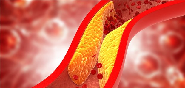 Arterie mit Plaque: Raucher mit peripherer arterieller Verschlusskrankheit sollten nach Revaskularisation im Blick behalten werden: Das Risiko für postprozedurale Komplikationen ist deutlich erhöht.