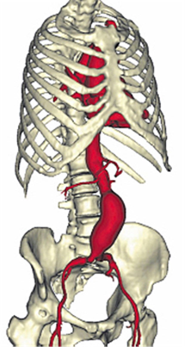 Arterielle Aneurysmen entstehen am häufigsten im Bereich der abdominalen Aorta, dort vorwiegend unterhalb der Nierenarterienabgänge.
