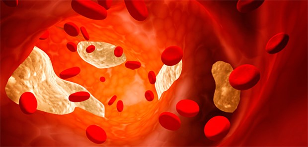 Cholesterin-Senkung unter schwierigsten Bedingungen Arterielle Plaques: Bei der LDL-Senkung könnten PCSK9-Hemmer eine neue Hoffnung sein.