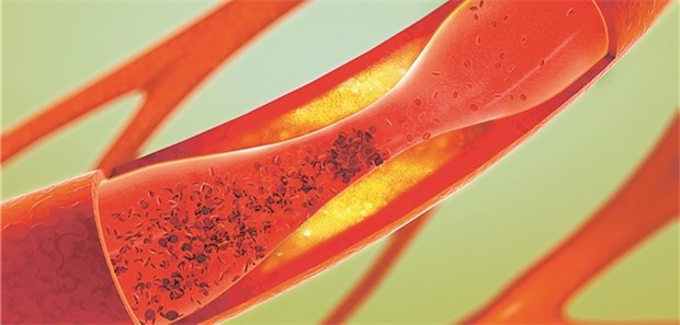 Keine Angst vor LDL-Cholesterin unter 10 mg/dl! Arteriosklerose: In der FOURIER-Studie senkte Evolocumab die LDL-Werte auf im Schnitt 30 mg/dl.