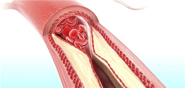 Artherosklerose: Eine Koronarkalk-Bestimmung kann bei symptomatischen Patienten das Einschätzen des kardiovaskulären Risikos erleichtern.