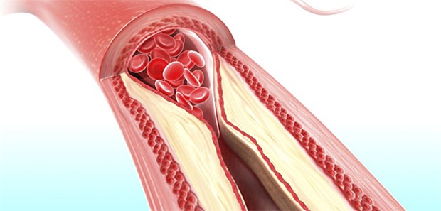 Artherosklerose: In Zukunft könnte sich die Dauer der dualen Plättchenhemmung am Schweregrad der KHK orientieren.