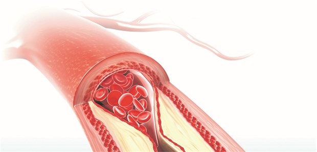 Lipide – Therapien jenseits der Statine Artherosklerose; für den LDL-Wert gilt weiter die Devise „the lower the better“.