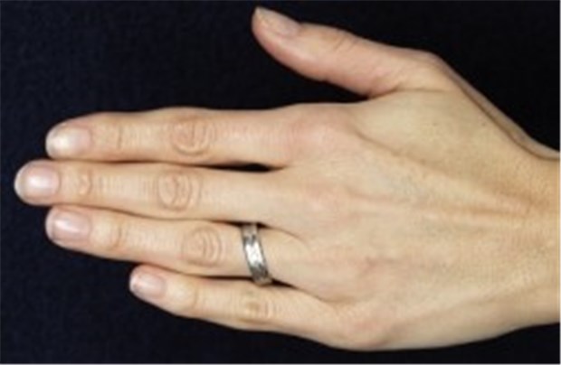 Ringfinger lang, Risiko für Arthrose hoch Arthrose-Entwarnung: Ringfinger ist nicht länger als Zeigefinger.