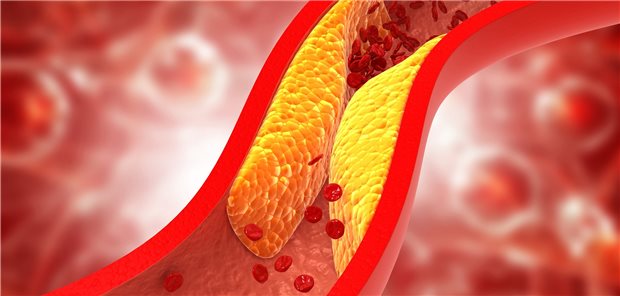 Atherosklerose: Die Autoren einer Studie plädieren für mehr kardiovaskuläre Vorsorge bei Patienten mit dieser Erkrankung.