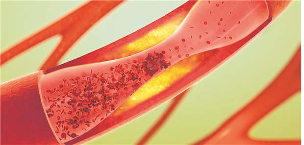 Atherosklerose: Eine aktuelle Analyse deutet darauf hin, dass eine Kalzium-Supplementierung Kalkablagerungen in den Koronararterien begünstigen könnte.