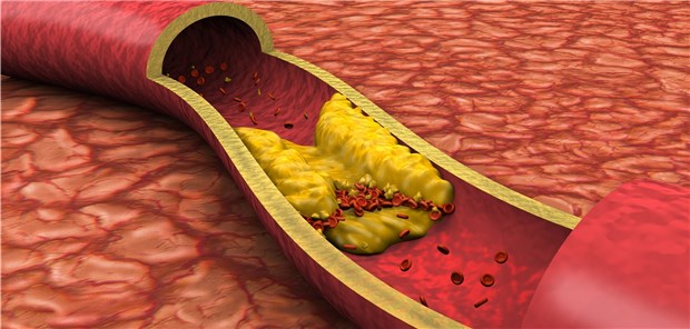 Atherosklerose: In der OSLER-1-Studie lagen 67 Prozent aller unter Evolocumab-Behandlung gemessenen LDL-C-Werte im Bereich 70mg/dl. 