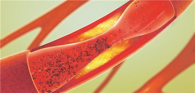 Atherosklerose: LDL-Partikel mit bestimmter Zusammensetzung neigen zur Aggregation.