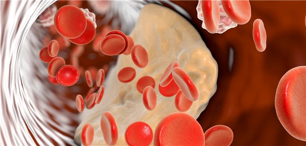 Atherosklerose: Niedrige LDL-Werte nützen auch Apoplexie-Patienten.