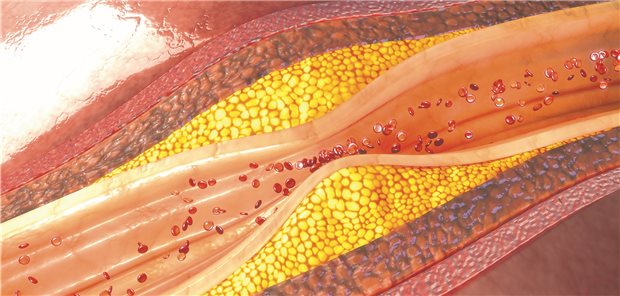 Atherosklerose: PCSK9-Hemmer richten sich gegen ein Enzym, das LDL-Rezeptoren an der Zellmembran von Leberzellen abbaut.