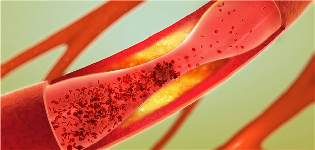 Atherosklerosen werden durch hohe Spiegel von Lipoprotein(a) begünstigt.