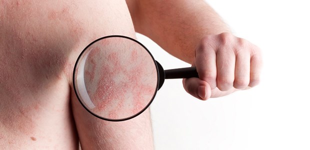 Stau und Entzündung durch Biofilm auf der Haut Atopische Dermatitis: Biofilme von Staphylokokken könnten die Läsionen begünstigen.