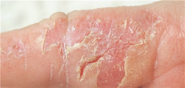 Bei schwerem Ekzem gezielte Therapie Atopische Dermatitis: Neue Substanzen bieten Chancen bei schwerem Ekzem.