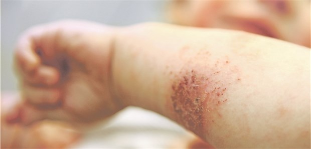 Mit Probiotikamix sinkt Bedarf an Kortison bei Neurodermitis Atopische Dermatitis bei einem Kind; auch mit Probiotika werden Behandlungserfolge erzielt.