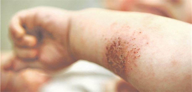 Allergierisiko am Erkrankungsalter ablesen Atopischer Dermatitis: Entwickeln sich Symptome früh, sind Kinder besonders allergiegefährdet.