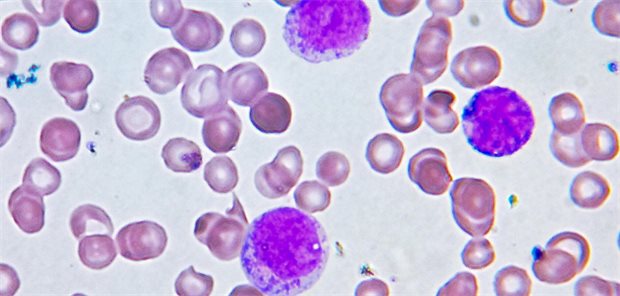 Atypische große mononukleäre Zellen mit Nukleolen: Ein signifikanter Teil der Patientinnen und Patienten mit bestimmten Formen von Leukämie hat bereits bei der Diagnose einen Immundefekt.