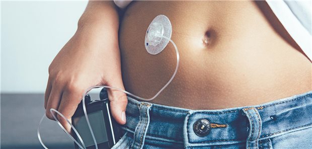 Auch als Closed Loop genannt sollen automatisierte Insulinabgabesysteme kontinuierlich die Glukosewerte messen. Dies ist vor allem für Kinder mit einem Diabetes mellitus vorteilhaft.