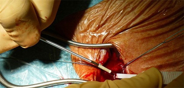 Auch bei anhaltendem Vorhofflimmern ist die Katheterablation der medikamentösen antiarrhythmischen Therapie überlegen