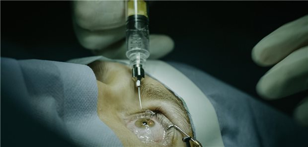 Intravitreale Injektion von Anti-VEGF-Therapien.