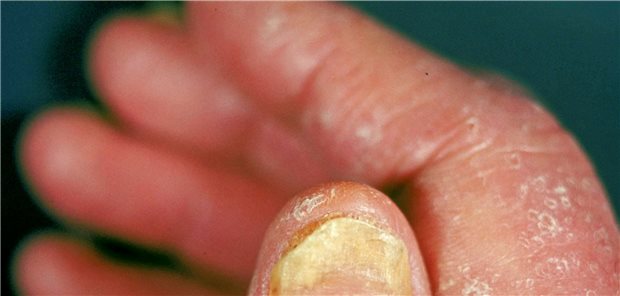 Auch der Hautbefall der PsA-Patienten wurde unter Guselkumab sehr gutkontrolliert.