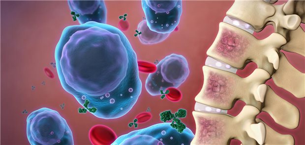Auch für Patienten mit mehrfach rezidiviertem Multiplem Myelom stehen mittlerweile Therapieoptionen zur Verfügung.