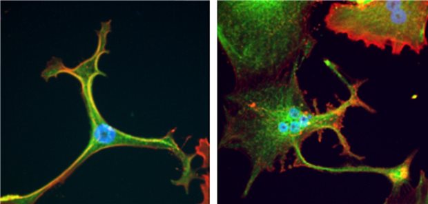Auch im Labor kultivierte Zellen einer Sarkomkrebszelllinie wachsen im Nährmedium unterschiedlich aus.