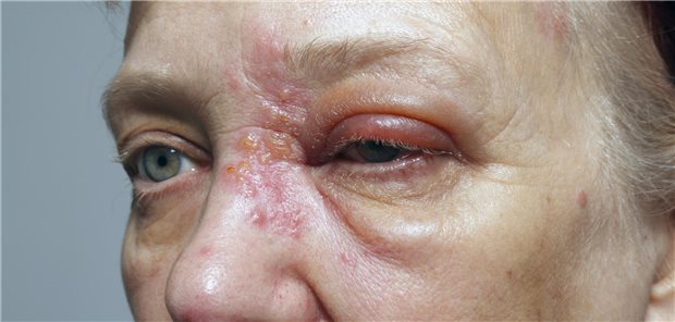 Foto einer älteren Frau mit geschwollenem Lid und Bläschen an der Nase.