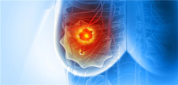 3D-rendering einer Brust mit einem Tumor.