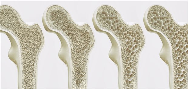 Auch topische Kortikoide begünstigen wohl die Entstehung von Osteoporose. Aus einer Studie geht hervor, dass das Risiko mit der Anwendungsdauer und Anzahl der Dosen steigt.