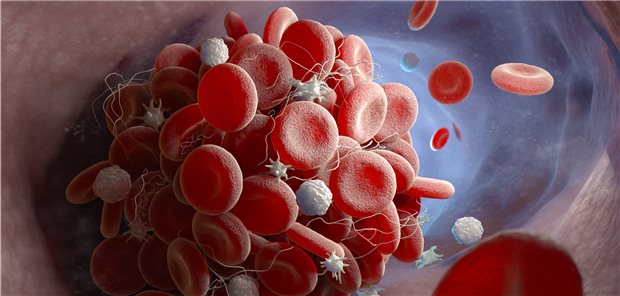 Auch unter einer NOAK-Therapie zum Schutz vor Thrombosen kann es gelegentlich zu schweren Blutungen kommen. In einer Metaanalyse wurde der Effekt einer Notfalltherapie untersucht.