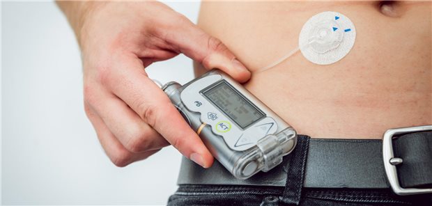 Diabetiker mit einer Insulinpumpe, die in seinem Bauch angeschlossen ist und die er am Gürtel trägt.