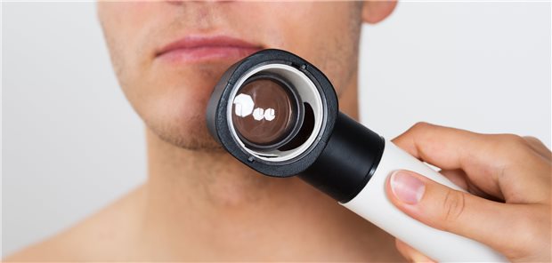 Auf Hautkrebszeichen achten: Bei Personen, die ein Spenderorgan empfangen haben, steigt einer Studie zufolge das Risiko – auch mehrfach – Hautkrebs zu entwickeln.