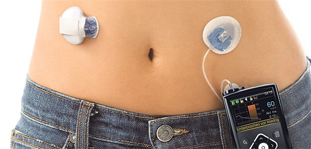 Ist die Zeit reif für das künstliche Pankreas? Auf dem Weg zum künstlichen Pankreas: Insulinpumpe sowie System zur kontinuierlichen Glukosemessung.