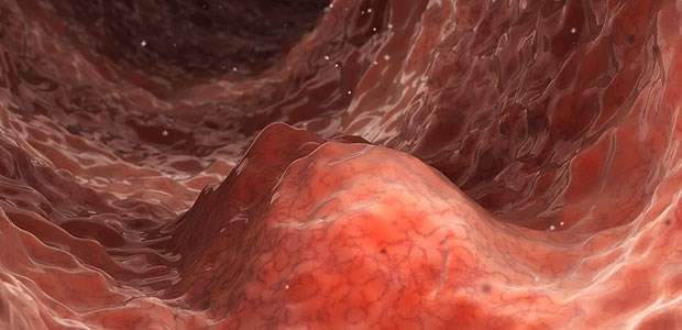Immuntests stechen Enzymtests aus Auf der Suche nach Darmkrebs sind immunologischen Tests den enzymatischen Verfahren überlegen.