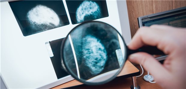 Auf der Suche nach Hinweisen auf ein Mamma-Ca. Forscher empfehlen, dass jetzt auch für Frauen, die nahe Verwandte mit Diagnose eines Mamma-Ca in situ haben, besondere Maßnahmen zur Krebsfrüherkennung definiert werden sollten.