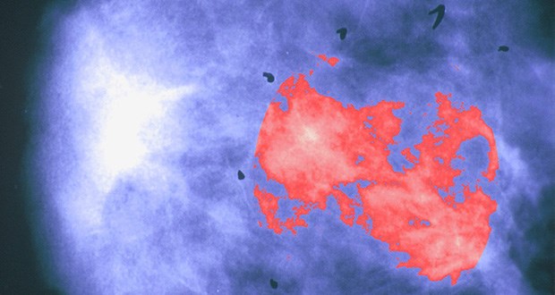 Auf rund 75000 Brustkrebs-Neuerkrankungen pro Jahr in Deutschland kommen lediglich 17500 Todesfälle.
